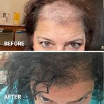 Myhair ny - Hair transplant surgery New York