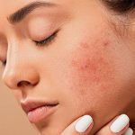 Rosacea Treatment in Dubai