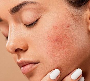 Rosacea Treatment in Dubai