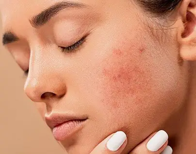 Rosacea Treatment in Dubai