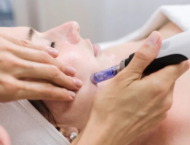 Skin needling and microdermabrasion__630x480-1 (1)