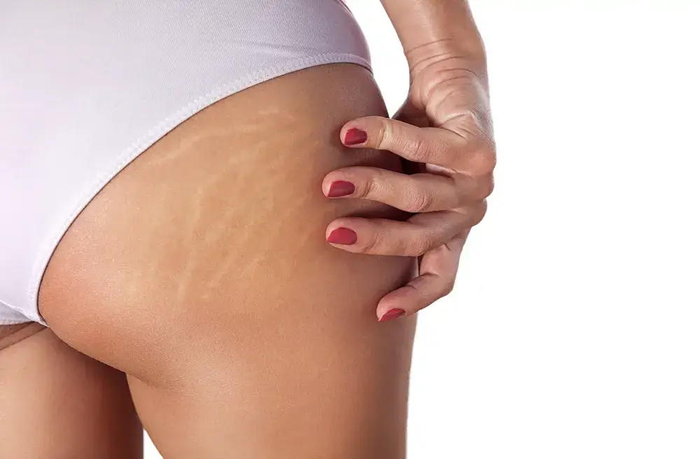 cost of Laser Stretch Marks Removal In Dubai