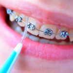 tips-to-clean-braces-3