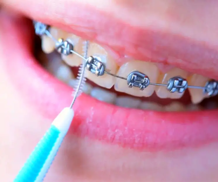 tips-to-clean-braces-3